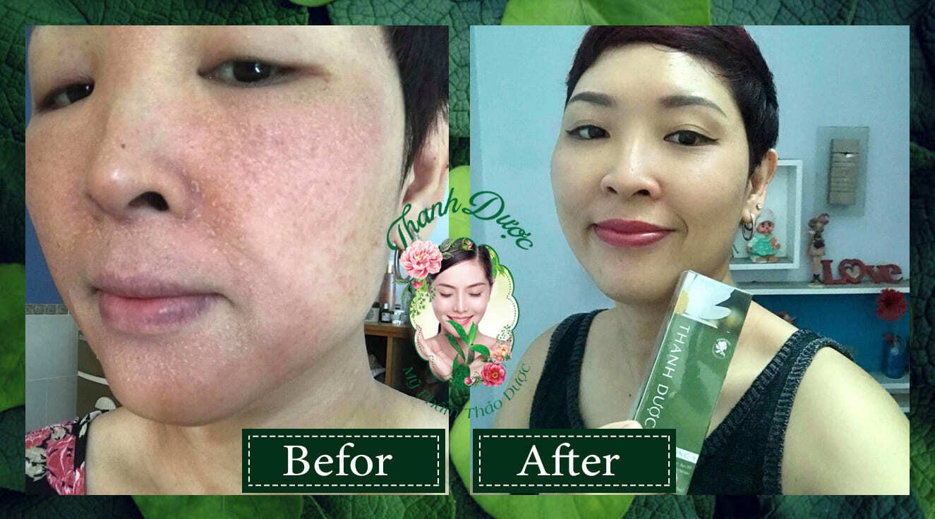 CLEARANCE SALE 30% Mỹ Phẩm Thanh Dược - L�RE Serum - 80 mL - 100% Brand New